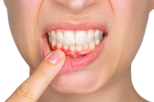 Ein Drittel der Bevölkerung leidet an Zahnfleischentzündung